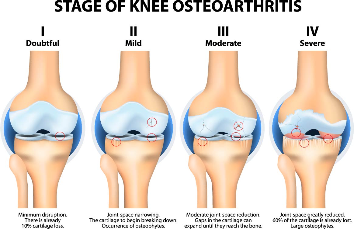 Osteoarthritis Spine Symptoms