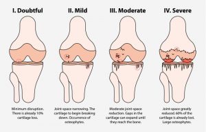 Diagram of knee joint illustrating how the osteoarthritis affects the cartilage in different stages of the disease.