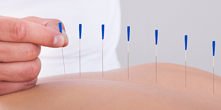 photograph of a physiotherapist performing dry needing acupuncture