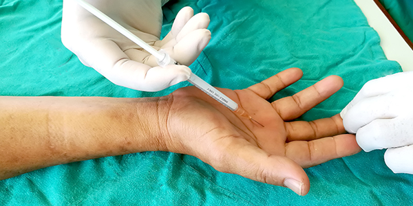 Photograph of a hand getting cortisone injections for trigger finger